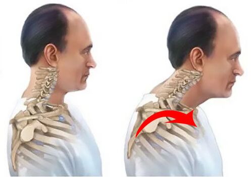 Sore spine