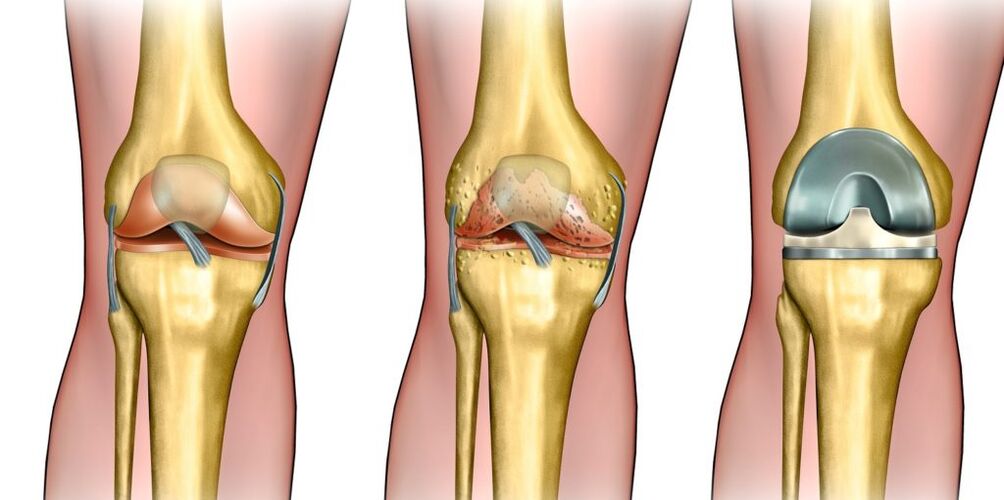 Knee arthrosis
