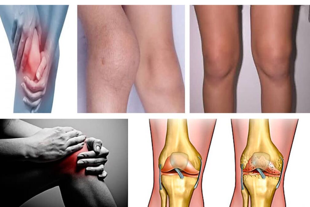 Symptoms of knee arthrosis